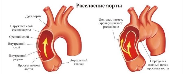 Расслоение аорты: первая помощь, симптомы, причины, методы диагностики и лечения