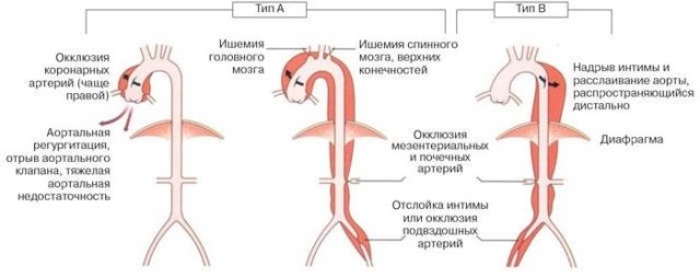 Расслоение аорты: первая помощь, симптомы, причины, методы диагностики и лечения