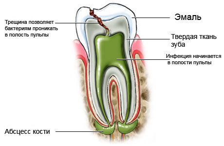 Растет зуб мудрости и болит десна: лечить или удалять, если зуб растет в бок, в щеку