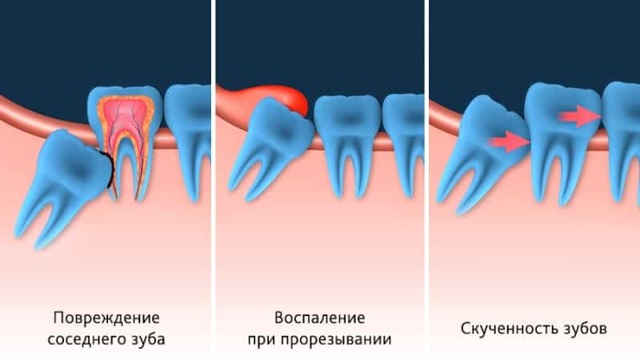 Растет зуб мудрости и болит десна: лечить или удалять, если зуб растет в бок, в щеку
