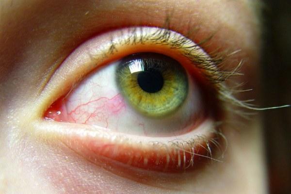 Раздражение, покраснение глаз: основные причины, клиническая картина, лечебные и профилактические мероприятия