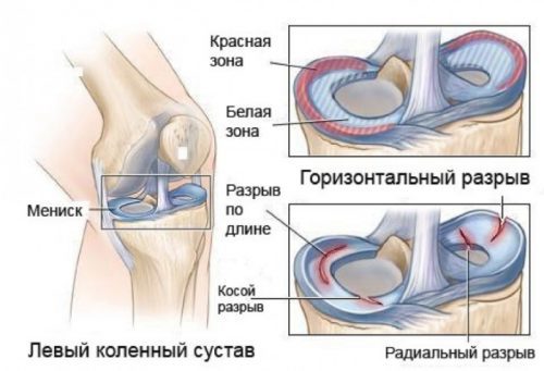 Разрыв мениска коленного сустава: группа риска, симптомы, медикаментозное и хирургическое лечение, период реабилитации
