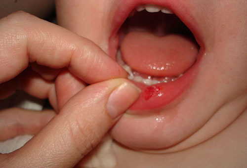 Ребенок разбил губу, обжог рот горячим, сломал зуб или челюсть, что делать – первая помощь
