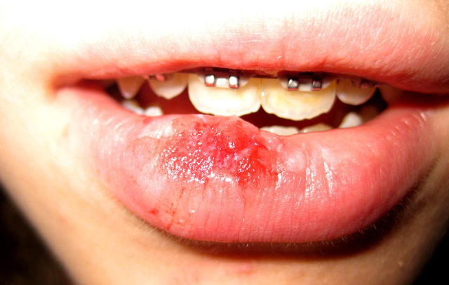 Ребенок разбил губу, обжог рот горячим, сломал зуб или челюсть, что делать – первая помощь