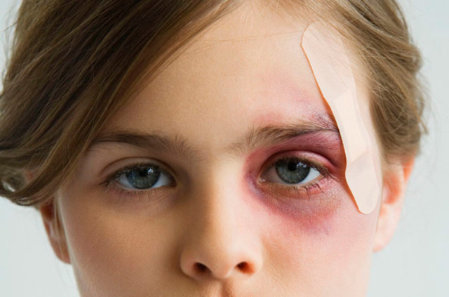 Ребенок ударился глазом: как снять боль и отечность, первые шаги при травме