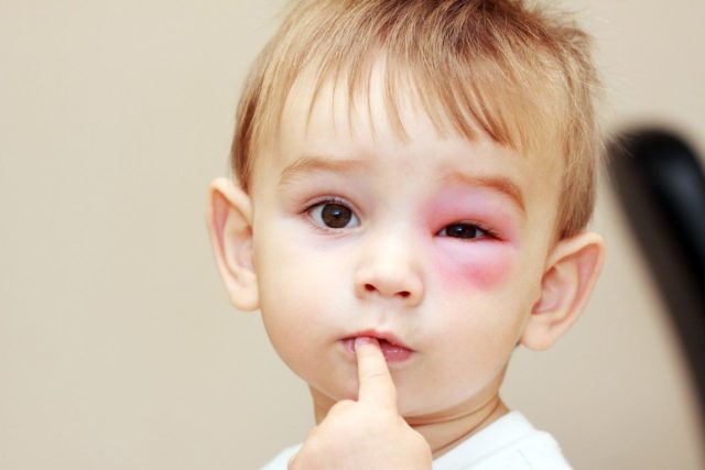 Ребенок ударился глазом: как снять боль и отечность, первые шаги при травме