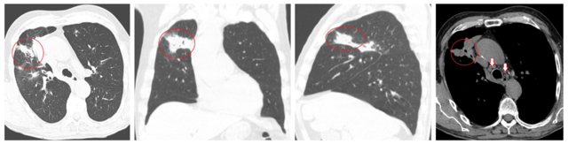 Рентген и компьютерная томография легких как методы диагностики туберкулеза и других патологий