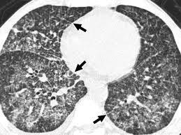 Рентген и компьютерная томография легких как методы диагностики туберкулеза и других патологий