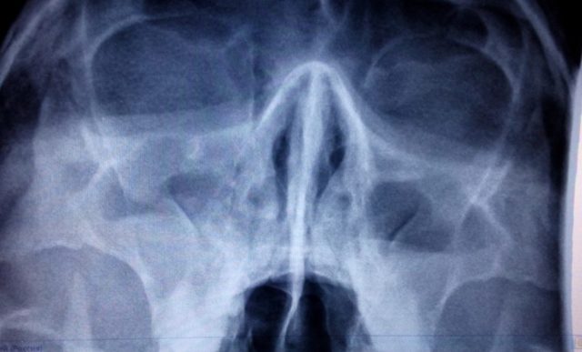 Рентген пазух носа: подготовка к процедуре, показания и противопоказания