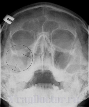 Рентген пазух носа: подготовка к процедуре, показания и противопоказания