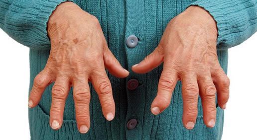 Ревматоидный артрит: симптомы, рецепты народной медицины для лечения заболевания