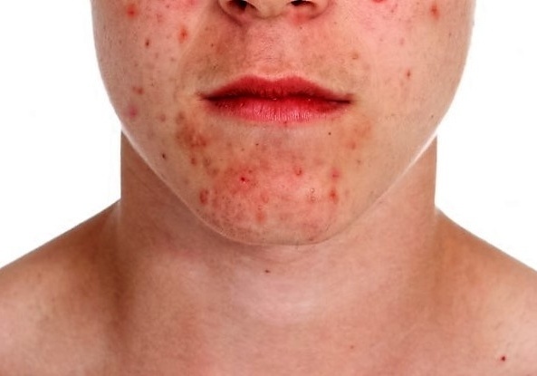 С чем связано появление сыпи на лице?