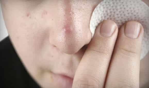 Салициловая кислота от прыщей: инструкция по применению препарата для кожи лица