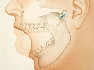 Щелкает челюсть при жевании и открытии рта: что это означает, к какому врачу обратиться?