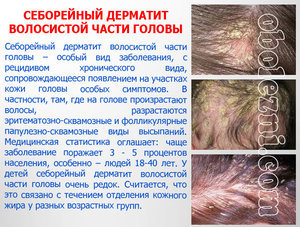 Себорейный дерматит — лечение лица, волосистой части головы и туловища