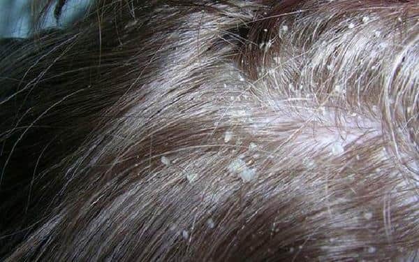 Себорейный дерматит — лечение лица, волосистой части головы и туловища