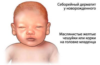 Себорейный дерматит у грудничка: как правильно снимать корочки у ребенка