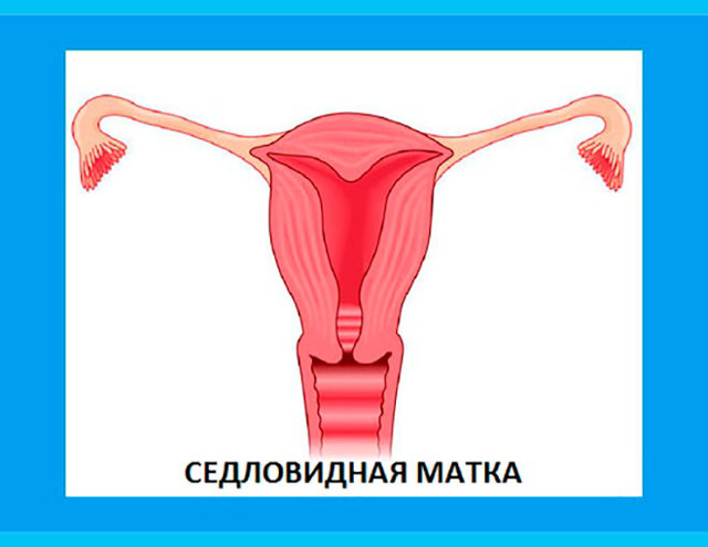 Седловидная матка: что это значит, схематичное изображение, причины возникновения, методы диагностики, особенности беременности и родов