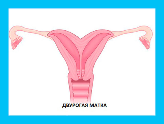 Седловидная матка: что это значит, схематичное изображение, причины возникновения, методы диагностики, особенности беременности и родов