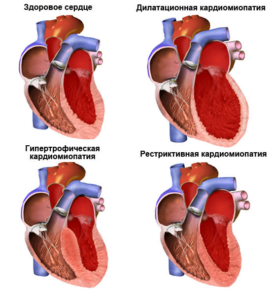 Сердечная недостаточность: симптомы и лечение, диагностика