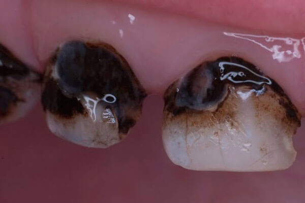 Серебрение зубов у детей при кариесе молочных зубов: что это, фото до и после, отзывы врачей и родителей