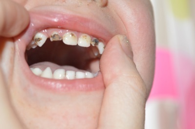 Серебрение зубов у детей при кариесе молочных зубов: что это, фото до и после, отзывы врачей и родителей