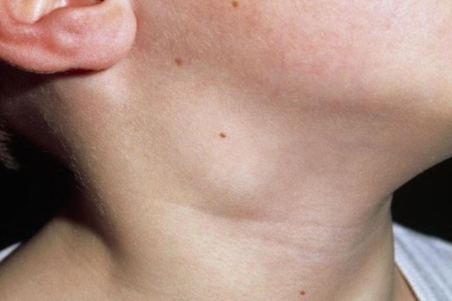 Шейный лимфаденит (воспаление лимфоузлов на шее): как лечить у взрослых и детей