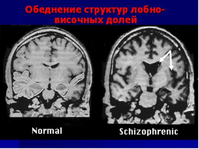 Шизофрения (психотическое расстройство): как проявляется, что активирует болезнь?