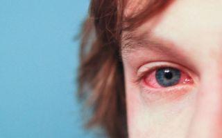 Симптомы аллергического конъюнктивита у ребёнка: подробные фото, эффективное лечение в домашних условиях