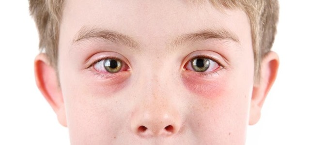 Симптомы аллергического конъюнктивита у ребёнка: подробные фото, эффективное лечение в домашних условиях