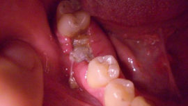 Симптомы и лечение альвеолита после удаления зуба: подробные фото воспалительного процесса