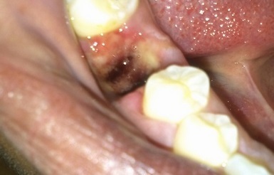Симптомы и лечение альвеолита после удаления зуба: подробные фото воспалительного процесса