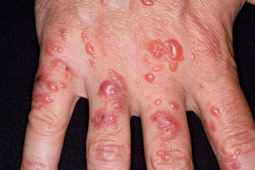 Симптомы и причины контактного дерматита, обзор эффективных средств для лечения заболевания