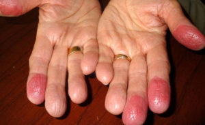 Симптомы и причины контактного дерматита, обзор эффективных средств для лечения заболевания