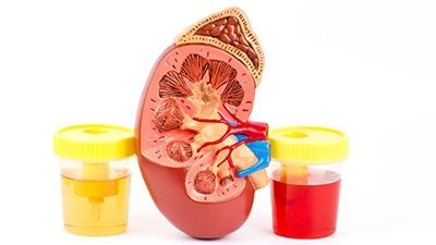 Симптомы и причины появления крови в моче, диагностика и лечение гематурии