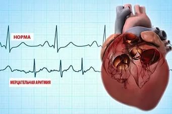 Симптомы и виды аритмии сердца, эффективные методы терапии народными средствами