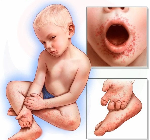 Синдром «рука-нога-рот»: как проявляется у взрослых и детей, что является причиной?
