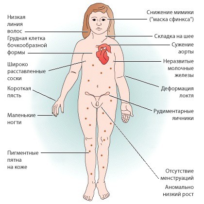 Синдром Шерешевского-Тернера: провоцирующие факторы, тип наследования, основные симптомы, поддерживающее лечение