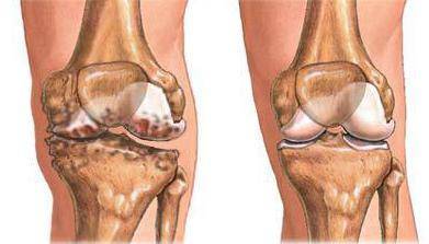 Синостоз коленного сустава: что это такое, симптомы, лечение, профилактика