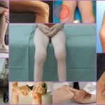 Синостоз коленного сустава: что это такое, симптомы, лечение, профилактика