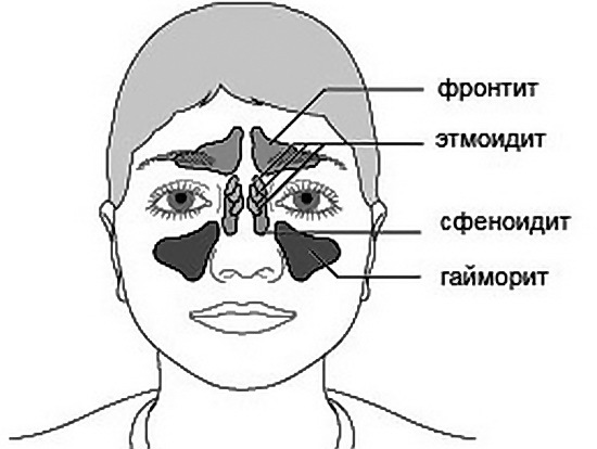 Синусит (sinusitis): причины возникновения, как проявляется и диагностируется