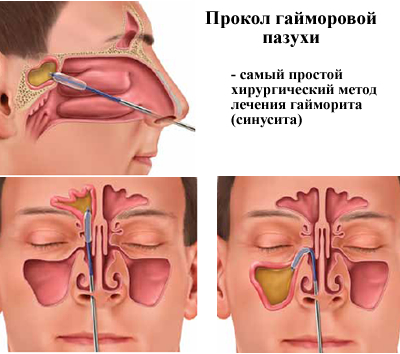 Синусит (sinusitis): причины возникновения, как проявляется и диагностируется
