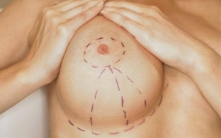 Слишком большая грудь: хирургическое вмешательство, косметические и народные средства, принципы диеты