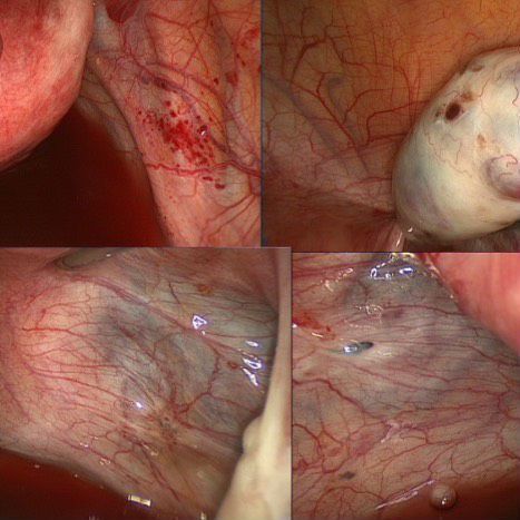 Сморщенный мочевой пузырь у мужчин и женщин: симптомы, диагностика, лечение
