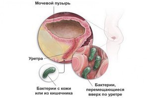 Сморщенный мочевой пузырь у мужчин и женщин: симптомы, диагностика, лечение
