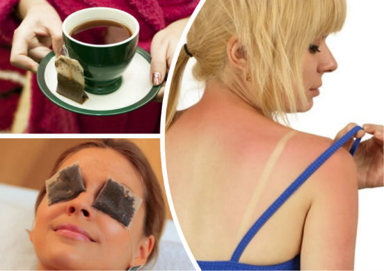 Солнечные ожоги: первые симптомы и помощь, что делать в домашних условиях