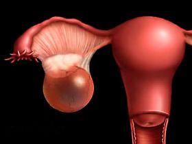 Сперматоцеле: причины развития кисты придатка яичка, сопутствующие симптомы, методы обследования и лечения