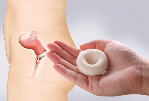 Способы контрацепции для женщин: противозачаточные гормональные средства, внутриматочная спираль и барьерный метод предохранения