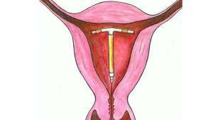 Способы контрацепции для женщин: противозачаточные гормональные средства, внутриматочная спираль и барьерный метод предохранения