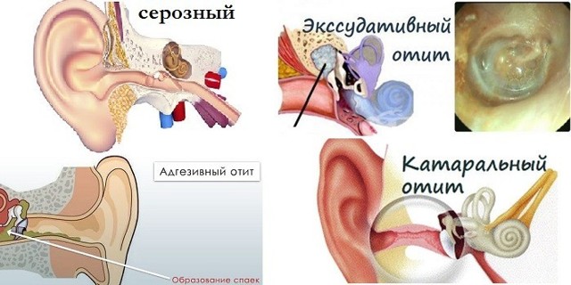 Средний отит уха у детей и взрослых: признаки, диагностика, методы лечения и профилактики